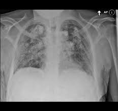Silicosis Radiology Case Radiopaedia Org Radiology Medical Humor Radiography