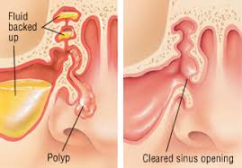 Stop smoking and get your weight down if you are overweight. Nasal Polyps Harvard Health