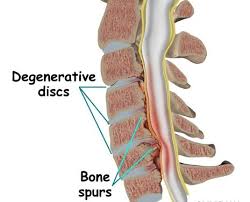 Bone Spurs Osteophytes Cervical Spinal Stenosis Bone Spurs Spinal Stenosis
