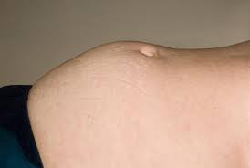 Pictures of swollen urethra female. Urinary Retention Red Flag Symptoms Gponline