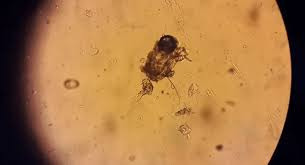 Image result for scabies norvegica