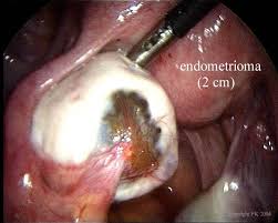 Endometriomas, also known as chocolate cysts or endometriotic cysts, are a localized form of endometriosis and are usually within the ovary. Endometriosis Images And Severity Gynsurgery Org