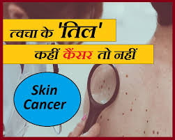 Navigating the choices for skin cancer treatment starts with understanding your options. à¤¤ à¤µà¤š à¤ªà¤° à¤¤ à¤œ à¤¸ à¤¬à¤¢ à¤°à¤¹ à¤¹ à¤¤ à¤² à¤¤ à¤¯à¤¹ à¤¹ à¤¸à¤•à¤¤ à¤¹ à¤• à¤¸à¤° à¤• à¤¸ à¤• à¤¤