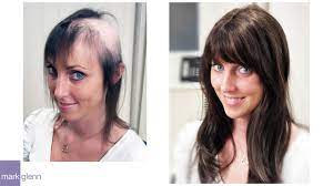 Female Hair Loss Solution Mark Glenn Hair Enhancement London Hair Loss Women Female Hair Loss Solutions Help Hair Loss