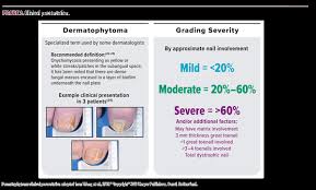 Image result for onychomycosis