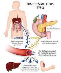 Сахарный диабет ii типа (инсулиннезависимый сд, type 2 diabetes). Diabetes Mellitus
