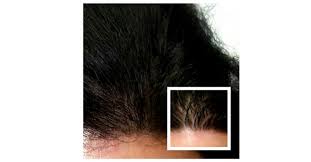 The reason why you may have an uneven hairline is because one side has more than the other. Got Uneven Hairline Here S What You Can Do