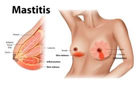 Image result for Mastitis