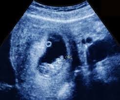 The anomaly scan, also commonly called as the level ii scan or the tiffa (targeted imaging for fetal anomalies) scan, is the most important scan of the second trimester. You Are 11 Weeks And 2 Days Pregnant Familyeducation