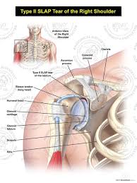 One arm of the biceps tendon (long head) also attaches to the shoulder labrum at its top. Type Ii Slap Tear Of The Right Labrum