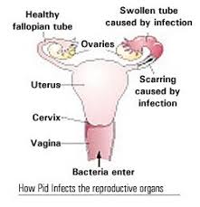 He's also a practicing infectious disease doctor with lots of. Pelvic Inflammatory Disease Don T Let It Sneak Up On You