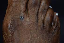 Thank you, {{form.email}}, for signing up. Skin Cancer Photo Gallery