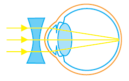 Di smp, anda telah mempelajari bahwa jika sebuah benda berada di depan sebuah lensa, bayangan akan dibentuk oleh lensa tersebut. Rumus Kekuatan Lensa Cembung Dan Cekung Idschool