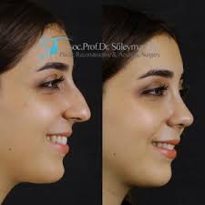 We did not find results for: Best Rhinoplasty Before And After Pictures Assoc Prof Dr Suleyman Tas