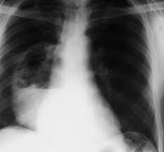 Typical signs of bacterial pneumonia include fever, difficulty breathing, lethargy and coughing. Lung Abscess Pulmonary Disorders Merck Manuals Professional Edition