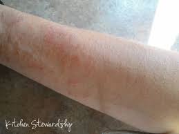 If You Ve Ever Eaten Sugar You Probably Have Candida Symptoms Yes You You In The Chair Read This Candida Symptoms Candida Rash Candida Symptoms Skin
