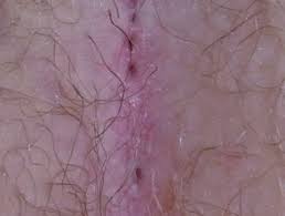 The exact mechanism is unknown, however, the current prevailing hypothesis is that pilonidal disease is an acquired condition. Pilonidal Disease Dermnet Nz