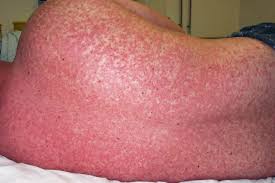 Image result for Measles