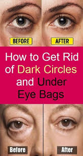 How To Get Rid Of Dark Circles And Under Eye Bags Eye Bag Remedies Undereye Bags Dark Circles Eye Bags
