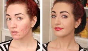 cover pitted acne s with makeup