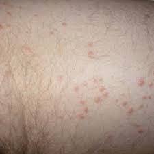 As well as medications, healthful dietary changes and. Eruptive Xanthomas Localised On Skin Of Arm Before Treatment Download Scientific Diagram