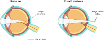 Image result for Presbyopia