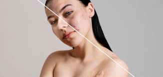 Kush Janë Produktet Më Të Mira Kundër Akneve & Pastrimit Të Fytyrës?