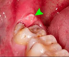 When you have a lingering pain in the back of your jaw, you begin asking yourself, how much will it is it beneficial to have all four wisdom teeth removed at once? Wisdom Tooth Removal Pain Advice And Cost Smileworks Liverpool