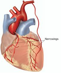 Coronary Artery Bypass Graft Healthdirect