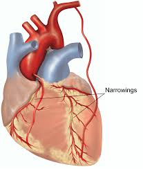 The coronary arteries supply oxygenated, and nutrient filled blood to the heart muscle. Coronary Artery Bypass Graft Healthdirect