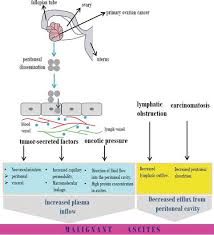 Ascites is the accumulation of fluid within the abdomen. Ascites In Advanced Ovarian Cancer Intechopen