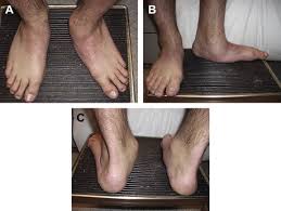 We did not find results for: The Adult Sequelae Of Treated Congenital Clubfoot Foot And Ankle Clinics