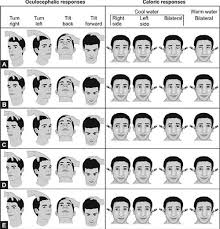 Image result for Oculovestibular Testing