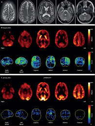 I love it and like the previous series think it gets better as the series progresses. Autoimmune Psychosis An International Consensus On An Approach To The Diagnosis And Management Of Psychosis Of Suspected Autoimmune Origin The Lancet Psychiatry