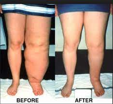Lymphedema Symptoms You Must Recognize And Act On