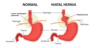 Hernia De Hiato Y Reflujo Gastrico Esofagico Dr Carlos Ballesta Lopez Clb