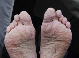 Suivez toute l'actu du football en direct : Trench Foot Symptoms Causes Treatment