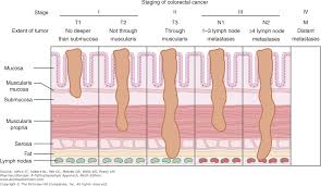 colon cancer disease state review with sample patient case