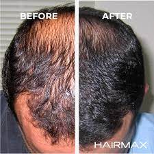 Lasers used to treat hair loss are in an entirely different category and differ in several major ways. Buy Hairmax Laser Cap For Hair Growth Powerflex 272 Lasers No Leds Fda Cleared Hair Laser Growth Treatment For Men And Women Ideal For Thinning Hair Treatment Women And Men Online In