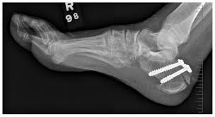 In rare cases, if the bone fragment and main bone are too far apart to fuse naturally, surgery may be necessary to reunite them. Avulsion Fracture Of The Calcaneus Cmaj