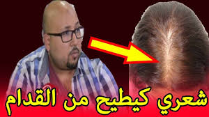 شعري كيطيح من القدام و بغيت وصفة للحد من تساقط الشعر من الامام Youtube Hair Movie Posters Movies