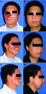See the complete profile on . Aesthetic Results Panel A Shows The Disfigured Face Before The Download Scientific Diagram