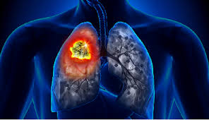 This is a way to reduce the number of people who die from lung therefore, many people who are screened will have further tests without actually having lung cancer. Blog 7 Facts You Need To Know About Lung Cancer Nfcr