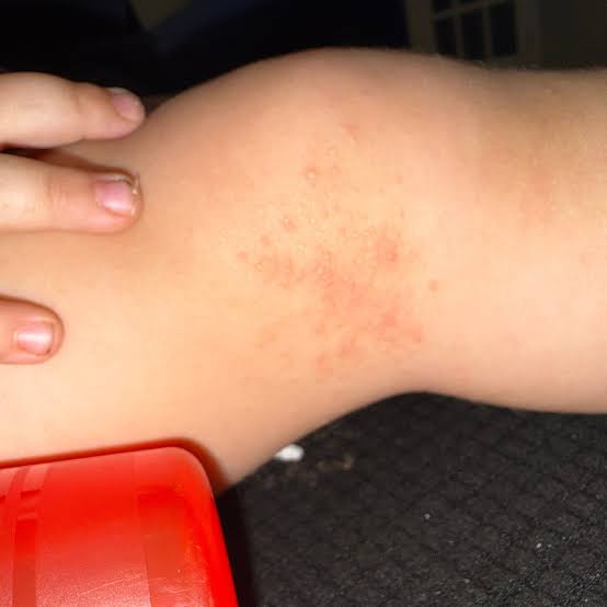 My toddler woke up with these tiny red bumps clustered all around his  ankles The nurse line is completely busy and he keeps scratching them What  is this