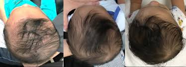 Helmet Treatment for Plagiocephaly