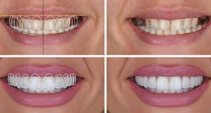 Digital Smile Design: The Future of Customized Smiles