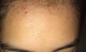 When you're in the shower, make sure you wash and condition your hair first, and then wash your face. Hairline Acne What Is It And How Do You Get Rid Of It Skincareaddicts