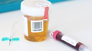Krebsdiagnostik Urin Statt Blut