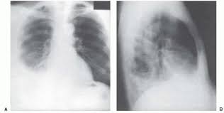 Pleural effusions occur as a result of increased fluid formation and/or reduced fluid resorption. Radiographic Examinations Thoracic Key