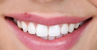 If the cold sore scab is itching, apply. Cold Sore Treatment Mosman Hugh Fleming Dentistry